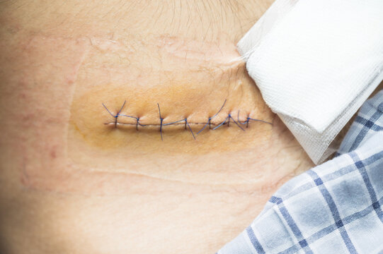 Nurse or Doctor hand treating the wound patient to clean the wound after stitches patients appendectomy surgery.