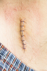 Nurse or Doctor hand treating the wound patient to clean the wound after stitches patients appendectomy surgery.