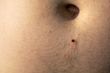 Fototapeta premium Sucking tick on human skin. Ixodes ricinus. Bloated parasite bitten into pink irritated epidermis. Dangerous insect mite. Encephalitis, Lyme disease infection, borreliosis.