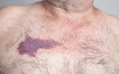 Naklejka premium Birthmark on the skin of man.