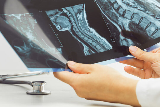 Female doctors hand pointing at x-ray or MRI medical imaging with a head and neck condition. Spinal cord, blood vessels. Neuro medicine. Healthcare and medicine. Injury. Bone tissues.