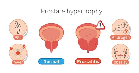 Male healthy and unhealthy prostate, cause of prostate hypertrophy and inflammation isolated on white background