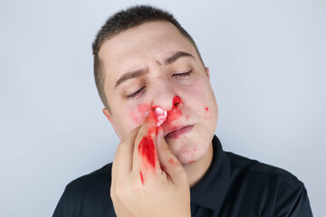 The man has a broken nose after a fight. Blood on hands, cheeks and nose. The consequences of...