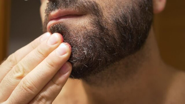 Detail of the man's chin with seborrheic dermatitis in the beard area. Dry skin peels off and causes itching and dandruff.