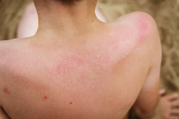 Fototapeta premium Skin damage after sunburn. Child's back.