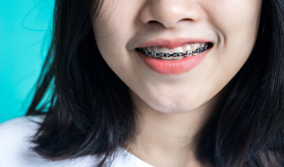 Asian woman wearing detal braces pointing to tooth sample and smiling with her healthy white teeth isolated shot on blue blackground.