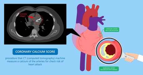 Cardiac Calcium Scoring chest health signs X-ray block treat blood Heart Score cath cell pain exam clot risk test Scan lab fat CAD CAC CT