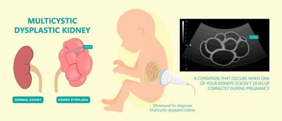 kidney damage UTI scan test tube VCUG acute VUR cyst exam flow pain birth block blood fetal fetus renal stone tract treat tumor urine x-ray cancer defect pelvic pelvis reflux sample system enlarge