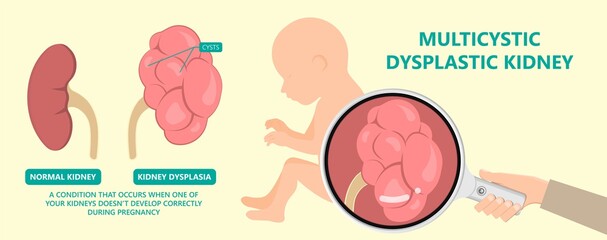 kidney damage UTI scan test tube VCUG acute VUR cyst exam flow pain birth block blood fetal fetus renal stone tract treat tumor urine x-ray cancer defect pelvic pelvis reflux sample system enlarge