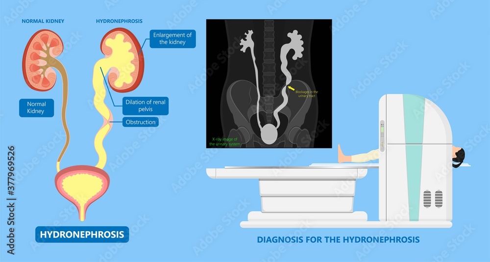 Poster kidney damage uti scan test tube vcug acute vur cyst exam flow pain birth block blood fetal fetus re