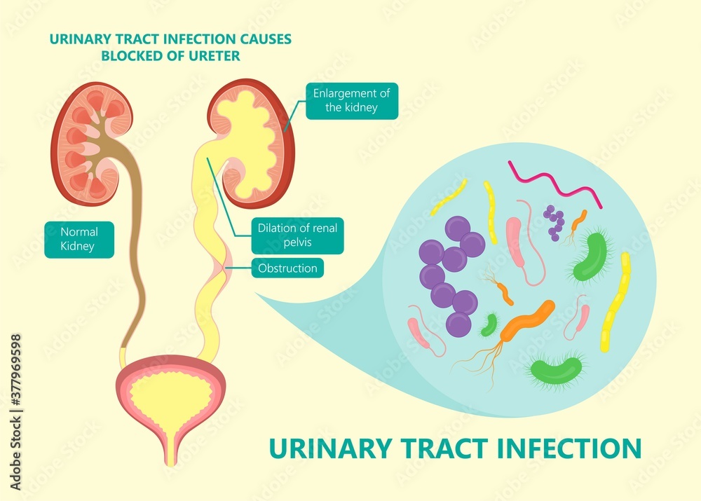 Poster kidney damage uti scan test tube vcug acute vur cyst exam flow pain birth block blood fetal fetus re