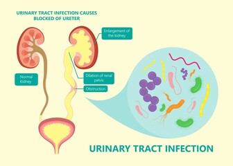 kidney damage UTI scan test tube VCUG acute VUR cyst exam flow pain birth block blood fetal fetus renal stone tract treat tumor urine x-ray cancer defect pelvic pelvis reflux sample system enlarge