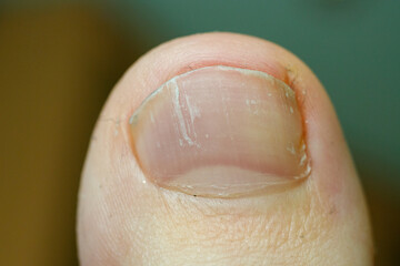 Nail layering on the leg