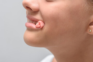 A bloody swab sticks out of the mouth of a ten-year-old girl after tooth extraction, close-up