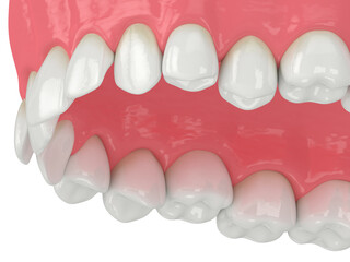 3d render of upper jaw with abnormal teeth position