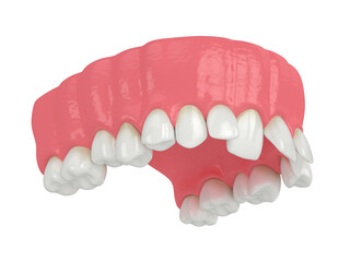 3d render of upper jaw with abnormal teeth position © Aleksandra Gigowska