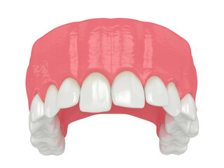 3d render of  upper jaw with abnormal teeth position © Aleksandra Gigowska