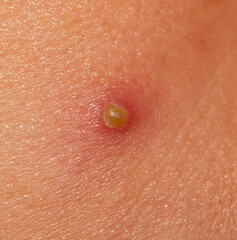 acne on the skin of the face as a background