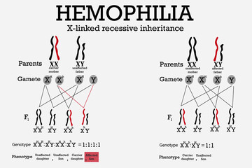 Hemophilia is a genetic disorder  which blood doesn't clot normally because it lacks sufficient blood-clotting proteins (clotting factors).