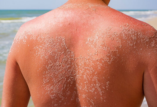 Dangerous sunburn on the sandy beach. Men with sun damaged peeling skin on the shoulders and back