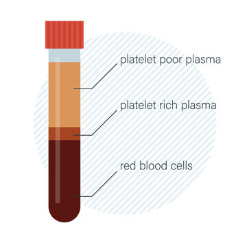 Platelet rich plasma in the tube. Separated blood for PRP hair and skin therapy. Medical laboratory equipment for PRP dermatology injection.