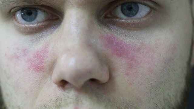 young man suffers from systemic lupus erythematosus, age spots of redness on the face, a rash.