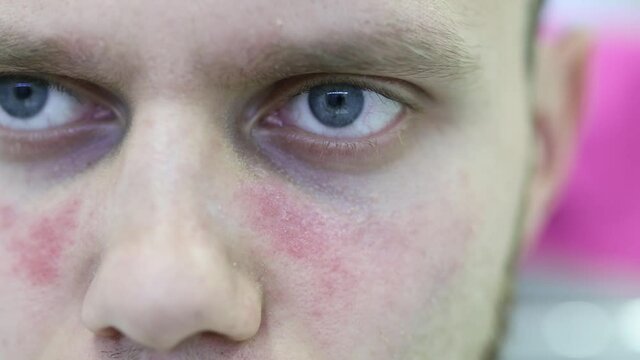 man suffers from systemic lupus erythematosus, age spots of redness on the face, a rash.
