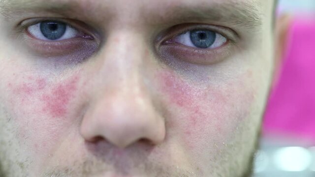man suffers from systemic lupus erythematosus, age spots of redness on the face, a rash.