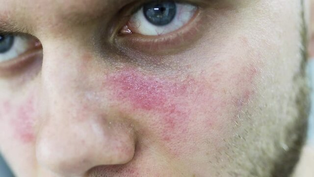 young man suffers from systemic lupus erythematosus, age spots of redness on the face, a rash.