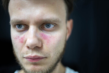 man suffers from systemic lupus erythematosus, age spots of redness on the face, a rash.