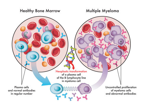 Medical illustration shows the transformation of plasma cells in healthy bone marrow into myeloma cells in multiple myeloma, due to DNA damage.