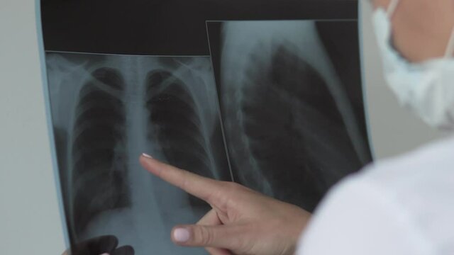 The doctor looks at an X-ray of the lungs of the covid-19. Close-up of the picture 