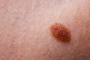 Closeup brown mole on caucasian woman skin.