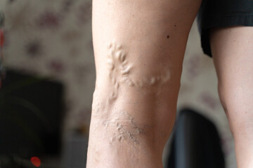 Varicose veins on woman legs indoors. Vascular health problem. Trombose on female legs