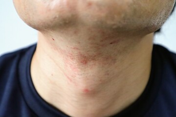 髭剃り後の肌荒れに悩む日本人男性のクローズアップ