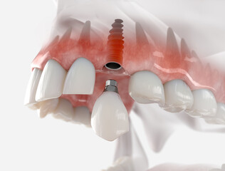 Replacement of maxillary canine with a dental implant. Realistic 3d illustration. - obrazy, fototapety, plakaty