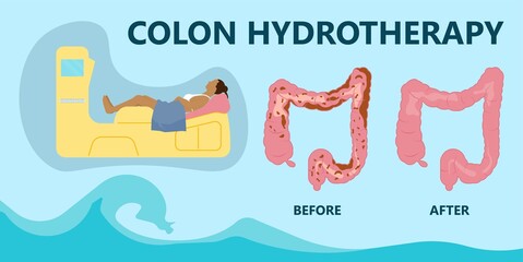 Naklejka premium IBS IBD stool detox cleanse diets body water herbal cleansing large Paradoxical Diarrhea Overflow liquid suppository relieve wast feces Weight loss