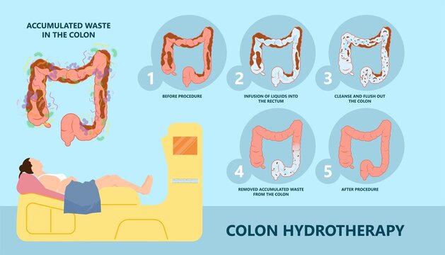 IBS IBD Stool Detox Cleanse Diets Body Water Herbal Cleansing Large Paradoxical Diarrhea Overflow Liquid Suppository Relieve Wast  Feces Weight Loss