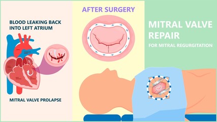 Obraz premium Cath Lab Atrial Septal Defect Tetralogy of Fallot Patent Foramen Ovale Mitral Valve Stenosis Heart Attack Ductus Arteriosus Doppler Coronary Artery Disease Congestive Congenital Valvular VSD exam leak