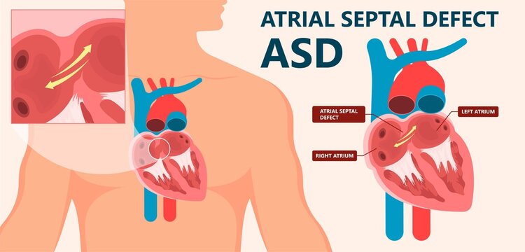 Cath Lab Atrial Septal Defect Tetralogy of Fallot Patent Foramen Ovale Mitral Valve Stenosis Heart Attack Ductus Arteriosus Doppler Coronary Artery Disease Congestive Congenital Valvular VSD exam leak