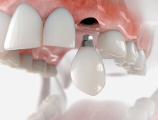 Replacement of maxillary canine with a dental implant. Realistic 3d illustration.