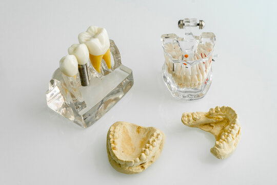 Dentures with human jaw bone on table