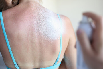 Woman back with red skin. Spray tanning on burnt leather. Man hand hold bottle of cream.