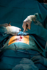  abdominal operation is performed in an operating room