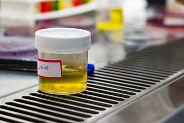Urine sample in an asceptic container for laboratory pathological biochemical microbiological and...