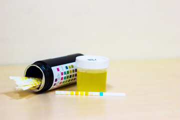 urine sample along with dip stick uristix for analyzing urine glucose protein in diabetes