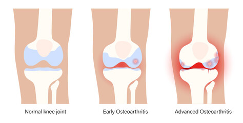 Arthritis in knee joint