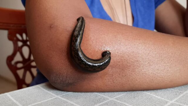 Treating Tennis Elbow with Leech Therapy