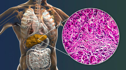 Liver with biliary cirrhosis - obrazy, fototapety, plakaty