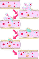 人間の血管修復イラスト2